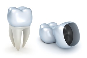 Dental Crowns