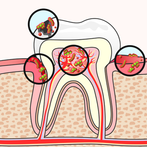 Tooth Section with Damage and Germs