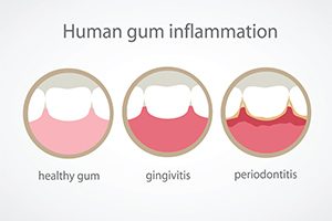 Human Gum Inflamation