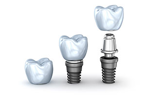 Dental Implants