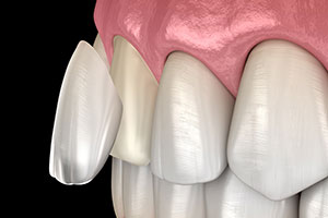 Dental Veneers