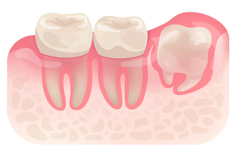 Buccoangular Impaction Buccoangular Impaction