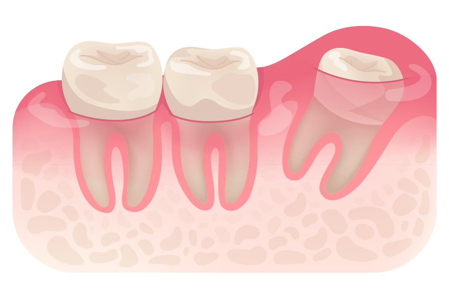 Distoangular Impaction Distoangular Impaction
