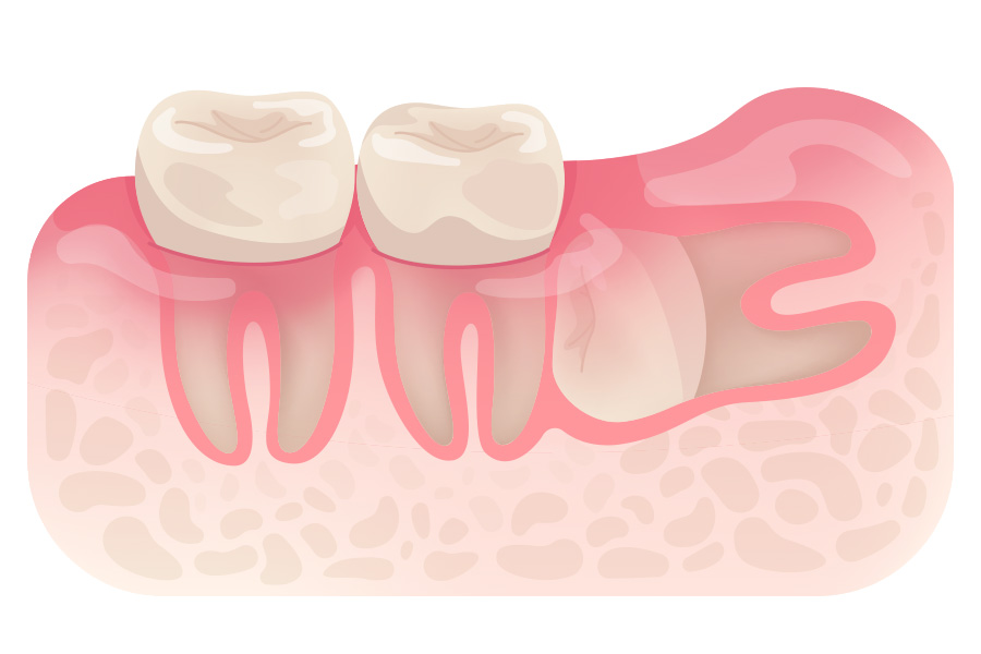Horizontal Impaction Horizontal Impaction