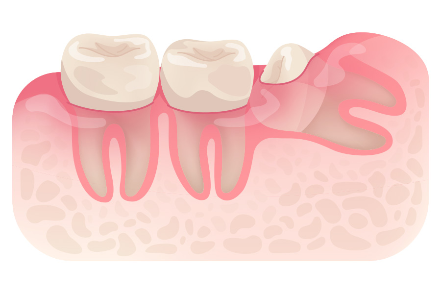 Partial Impaction Partial Impaction