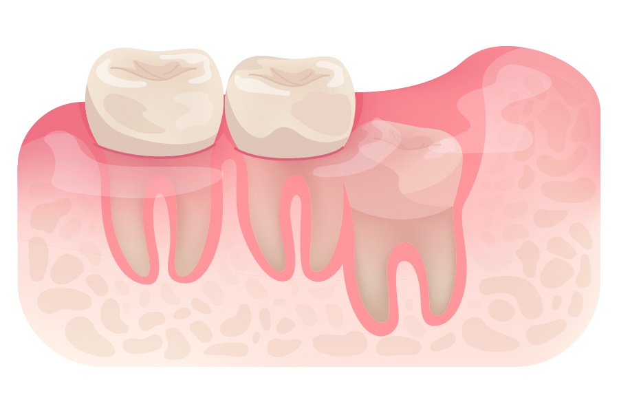 Vertical Impaction Vertical Impaction