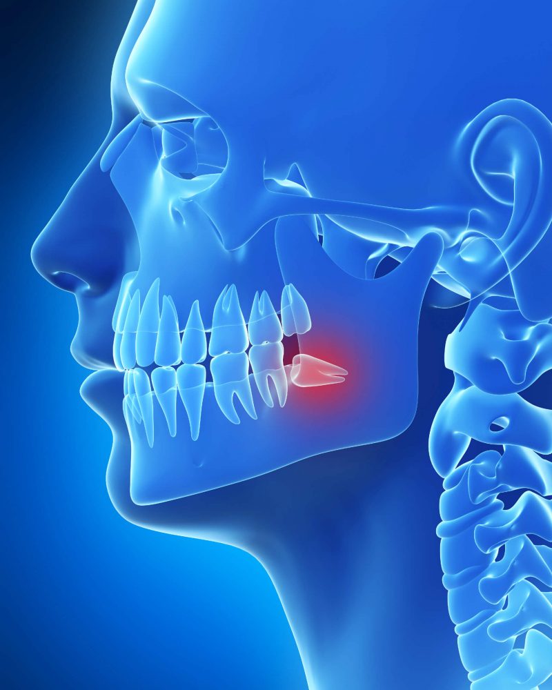 Wisdom Teeth Removal Wisdom Teeth Removal